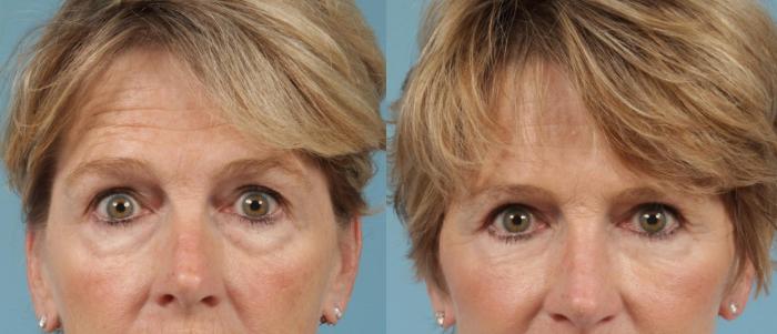 Before & After Blepharoplasty by Dr. Mustoe Case 1059 Front View in Chicago, IL