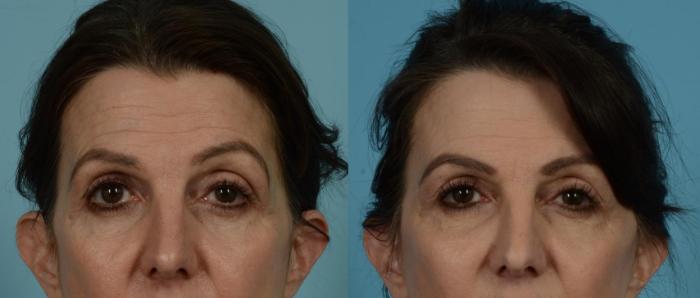 Before & After Blepharoplasty by Dr. Mustoe Case 1061 Front View in Chicago, IL