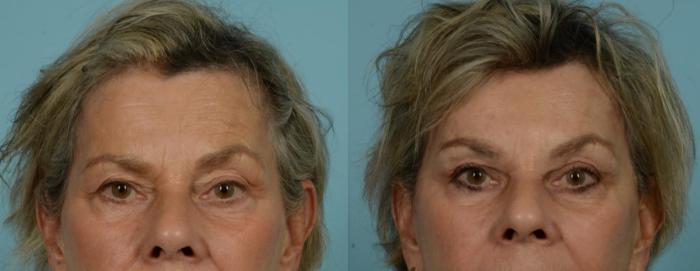 Before & After Blepharoplasty by Dr. Mustoe Case 1064 Front View in Chicago, IL