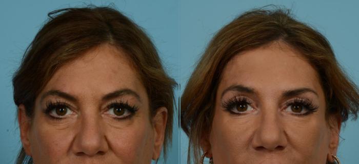 Before & After Blepharoplasty by Dr. Mustoe Case 1081 Front View in Chicago, IL