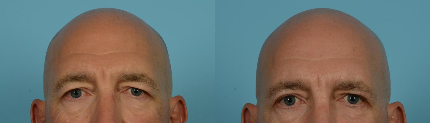 Before & After Blepharoplasty by Dr. Mustoe Case 1157 Front View in Chicago, IL