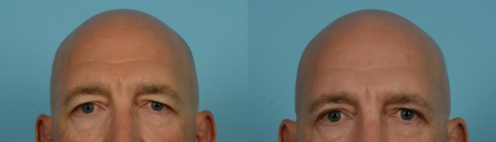 Before & After Blepharoplasty by Dr. Mustoe Case 1157 Front View in Chicago, IL
