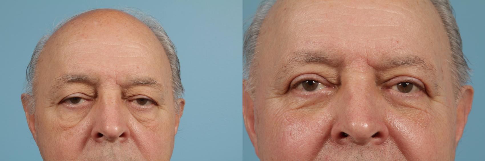 Before & After Blepharoplasty by Dr. Mustoe Case 134 View #1 View in Chicago, IL
