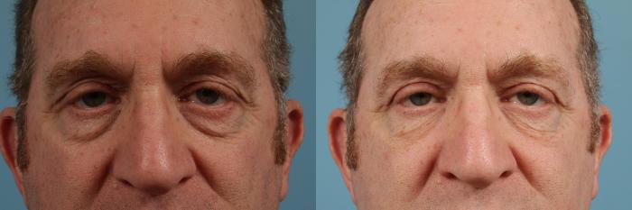 Before & After Blepharoplasty by Dr. Mustoe Case 137 View #1 View in Chicago, IL