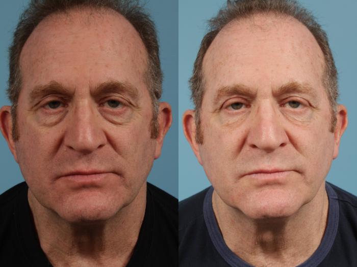 Before & After Blepharoplasty by Dr. Mustoe Case 137 View #2 View in Chicago, IL