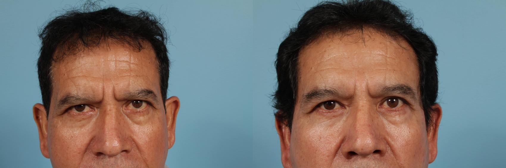 Before & After Blepharoplasty by Dr. Mustoe Case 150 View #1 View in Chicago, IL