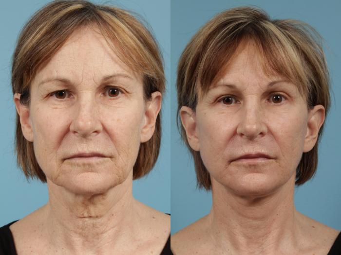 Before & After Blepharoplasty by Dr. Mustoe Case 152 View #1 View in Chicago, IL
