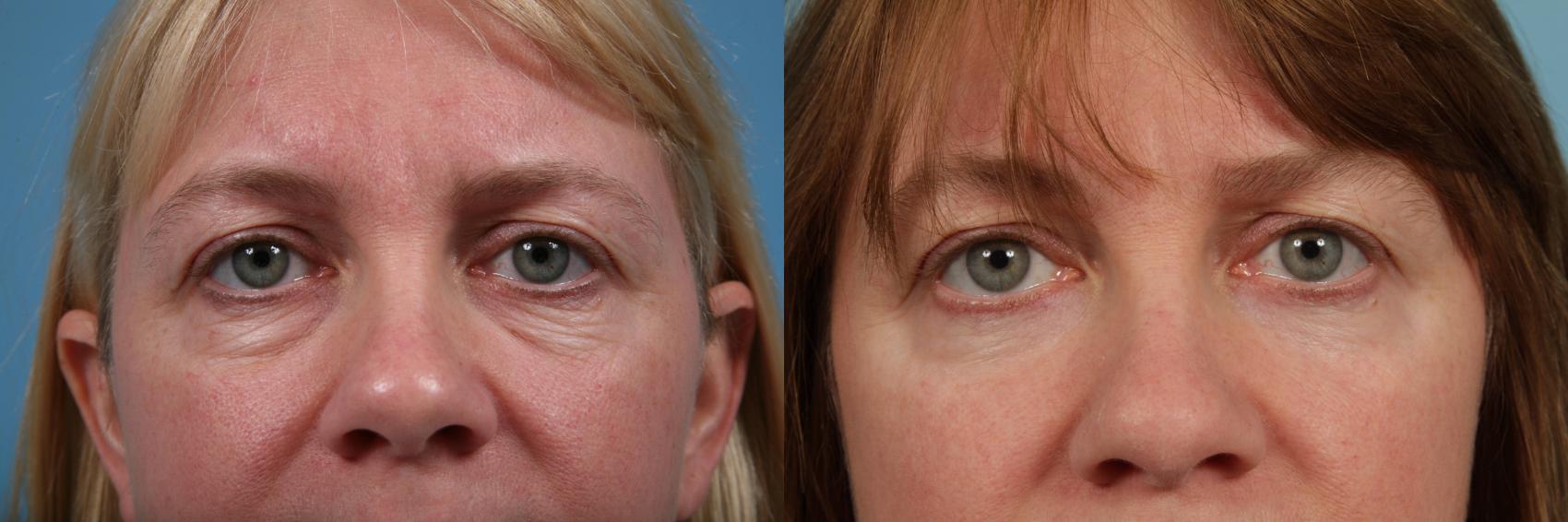 Before & After Blepharoplasty by Dr. Mustoe Case 159 View #1 View in Chicago, IL