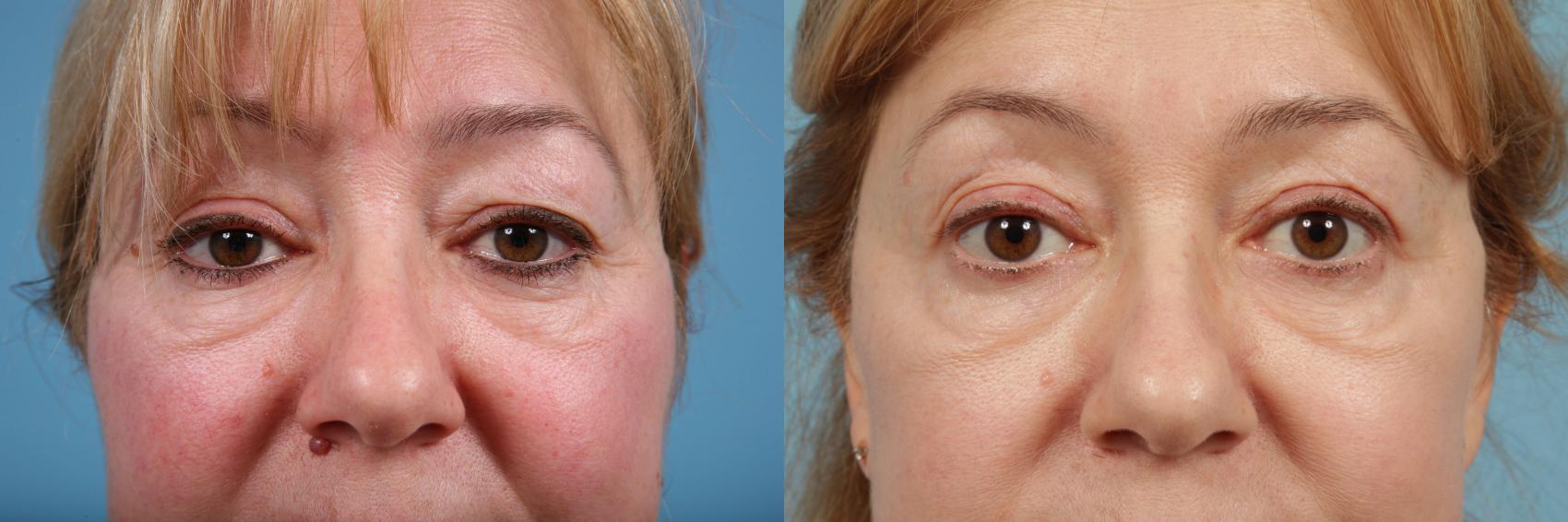 Before & After Blepharoplasty by Dr. Mustoe Case 184 View #1 View in Chicago, IL