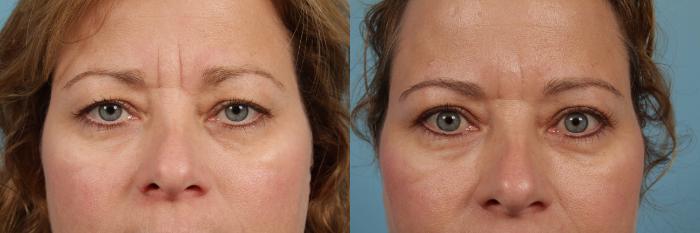 Before & After Blepharoplasty by Dr. Mustoe Case 228 View #1 View in Chicago, IL