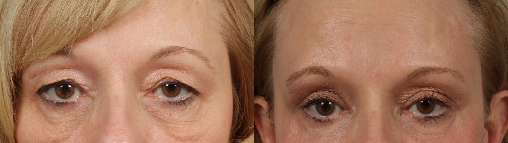 Before & After Blepharoplasty by Dr. Mustoe Case 236 Front View in Chicago, IL
