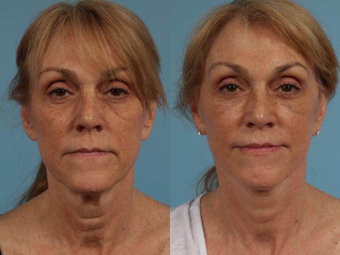 Before & After Blepharoplasty by Dr. Mustoe Case 281 View #1 View in Chicago, IL