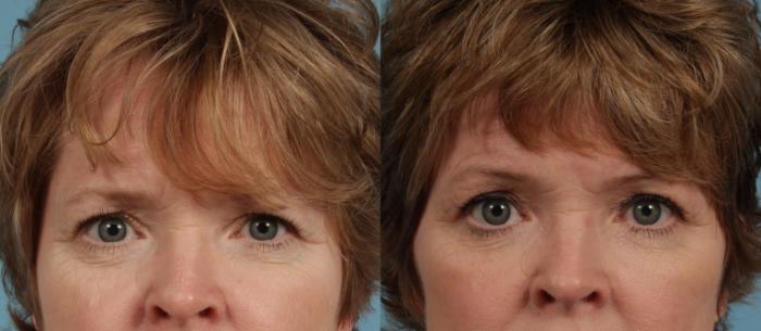Before & After Blepharoplasty by Dr. Mustoe Case 286 Front View in Chicago, IL