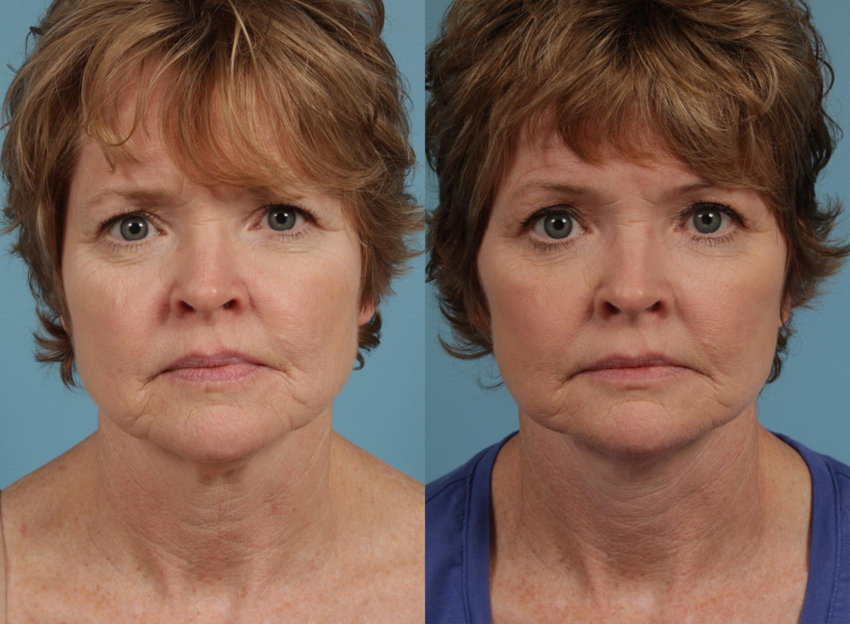 Before & After Blepharoplasty by Dr. Mustoe Case 286 View #1 View in Chicago, IL