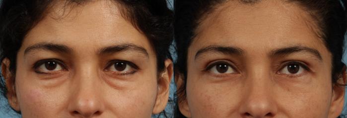 Before & After Blepharoplasty by Dr. Mustoe Case 319 Front View in Chicago, IL
