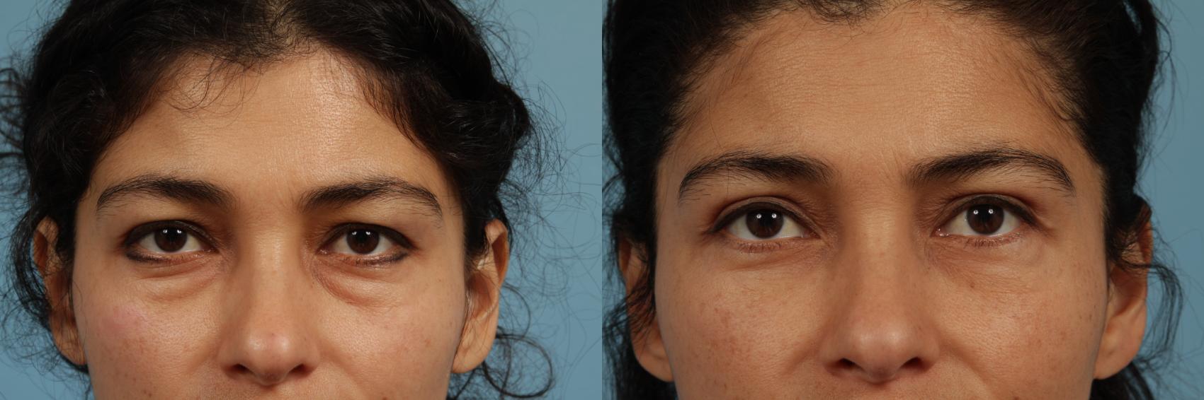 Before & After Blepharoplasty by Dr. Mustoe Case 319 View #1 View in Chicago, IL