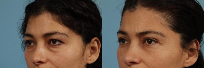 Before & After Blepharoplasty by Dr. Mustoe Case 319 View #2 View in Chicago, IL