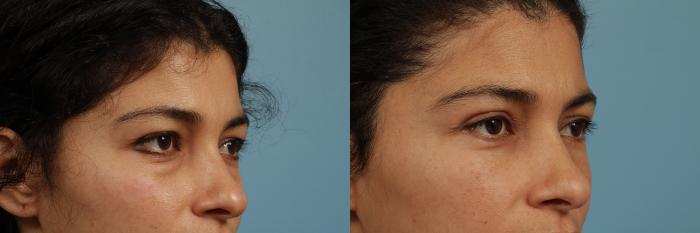 Before & After Blepharoplasty by Dr. Mustoe Case 319 View #3 View in Chicago, IL