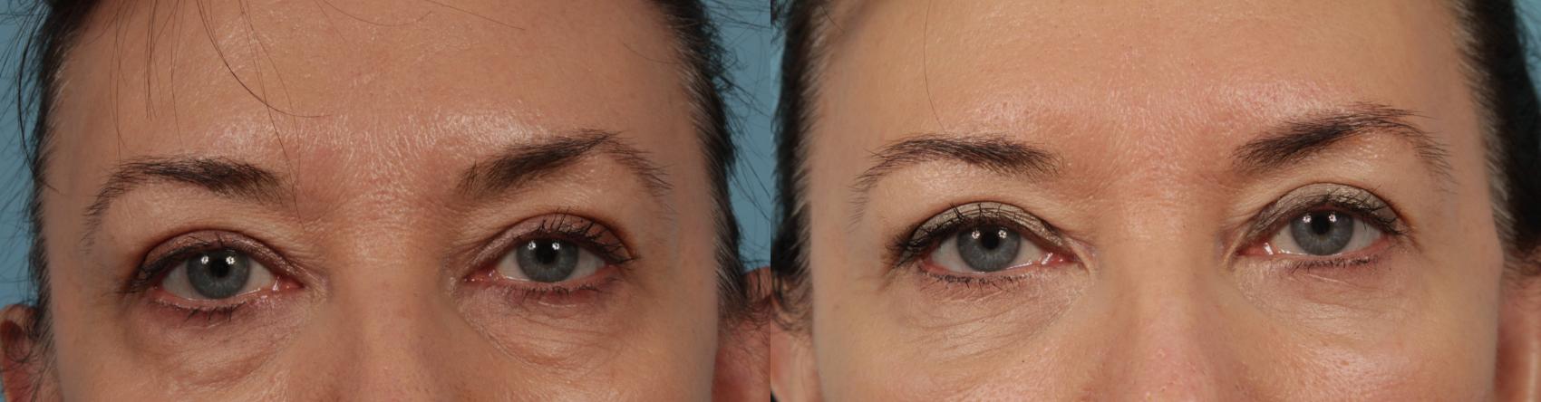 Before & After Blepharoplasty by Dr. Mustoe Case 331 Front View in Chicago, IL