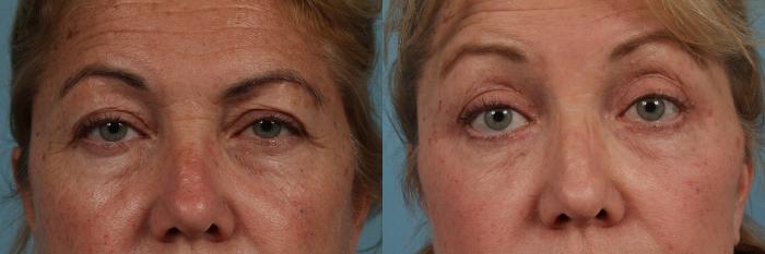 Before & After Blepharoplasty by Dr. Mustoe Case 334 View #1 View in Chicago, IL