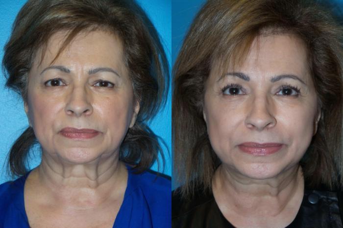 Before & After Blepharoplasty by Dr. Mustoe Case 404 View #1 View in Chicago, IL