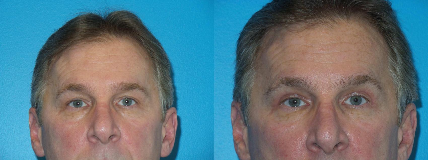 Before & After Blepharoplasty by Dr. Mustoe Case 407 View #1 View in Chicago, IL