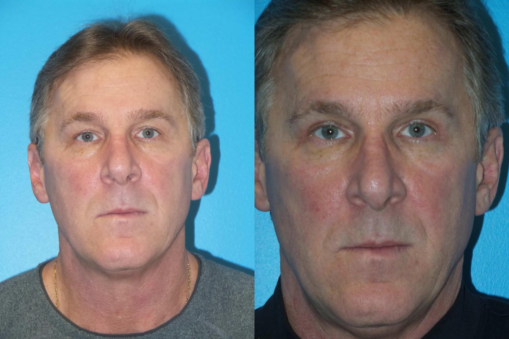 Before & After Blepharoplasty by Dr. Mustoe Case 407 View #2 View in Chicago, IL