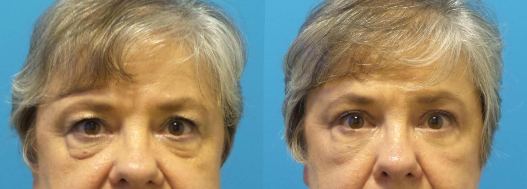 Before & After Blepharoplasty by Dr. Mustoe Case 439 Front View in Chicago, IL