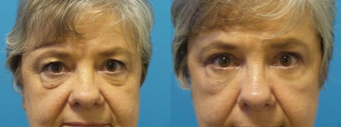 Before & After Blepharoplasty by Dr. Mustoe Case 439 View #1 View in Chicago, IL
