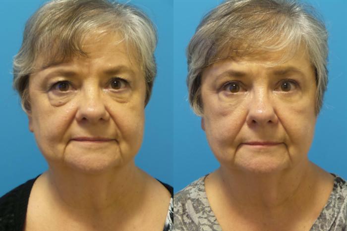 Before & After Blepharoplasty by Dr. Mustoe Case 439 View #2 View in Chicago, IL