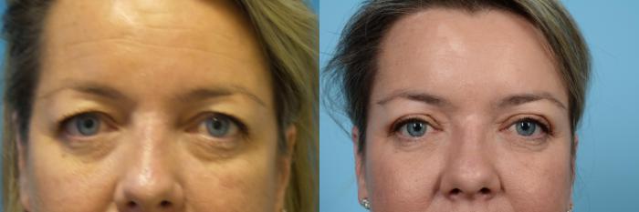 Before & After Brow Lift by Dr. Mustoe Case 441 View #1 View in Chicago, IL