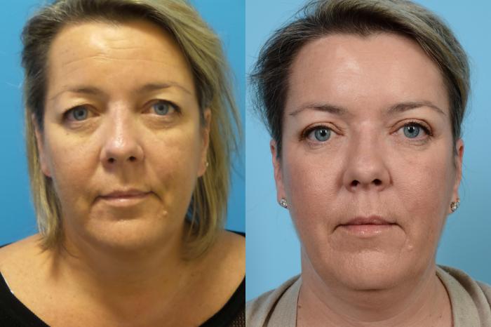 Before & After Brow Lift by Dr. Mustoe Case 441 View #2 View in Chicago, IL
