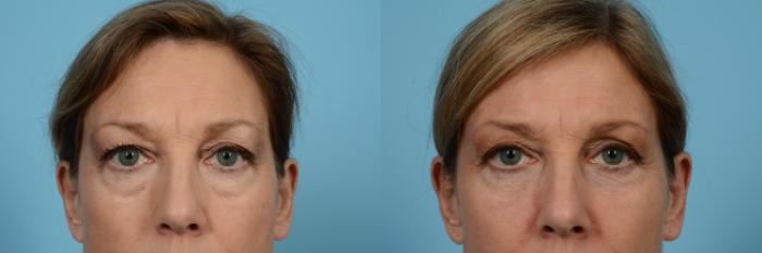 Before & After Blepharoplasty by Dr. Mustoe Case 523 View #1 View in Chicago, IL