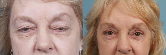 Before & After Blepharoplasty by Dr. Mustoe Case 63 View #1 View in Chicago, IL