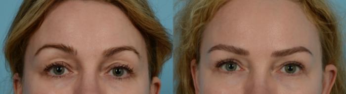 Before & After Blepharoplasty by Dr. Mustoe Case 735 Front View in Chicago, IL