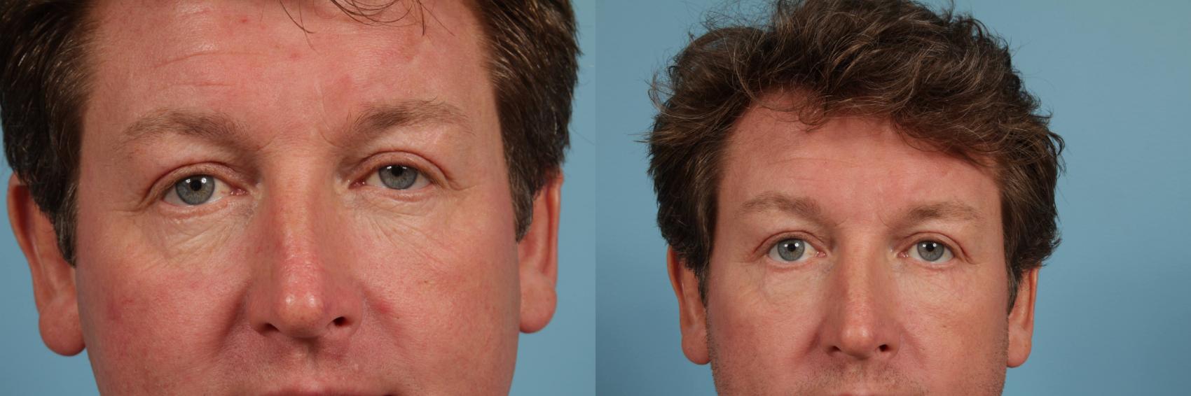 Before & After Blepharoplasty by Dr. Mustoe Case 90 Front View in Chicago, IL