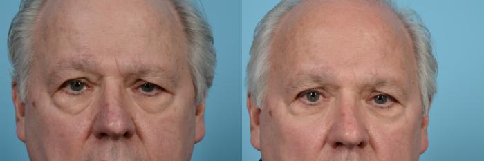 Before & After Brow Lift by Dr. Mustoe Case 958 Front View in Chicago, IL