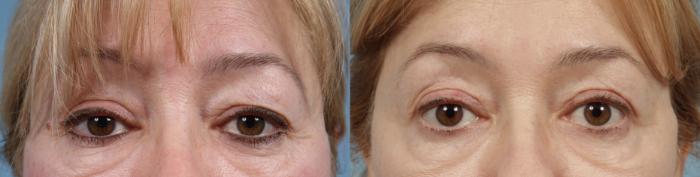 Before & After Brow Lift by Dr. Mustoe Case 963 Front View in Chicago, IL