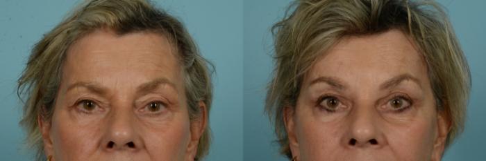 Before & After Blepharoplasty by Dr. Mustoe Case 999 Front View in Chicago, IL