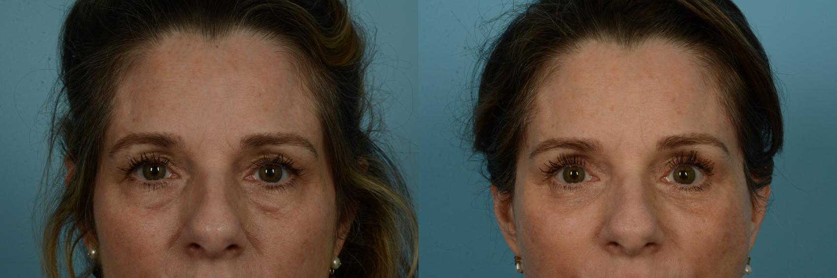Before & After Brow Lift by Dr. Sinno Case 1096 Front View in Chicago, IL