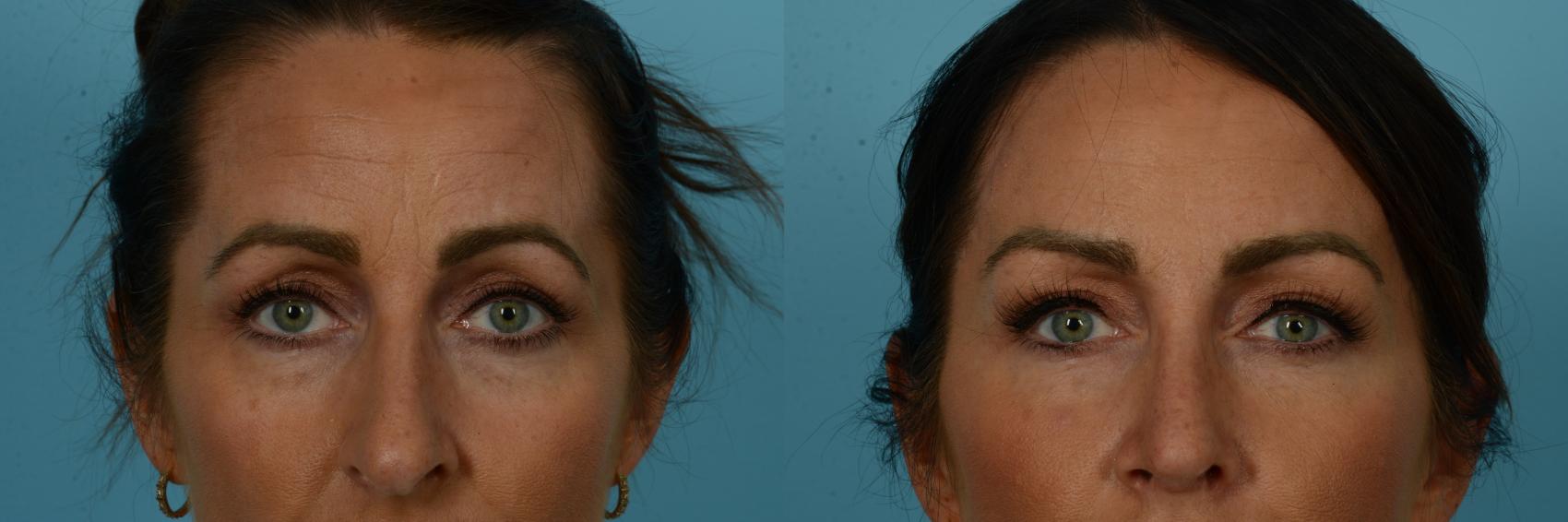 Before & After Blepharoplasty by Dr. Sinno Case 1118 Front View in Chicago, IL