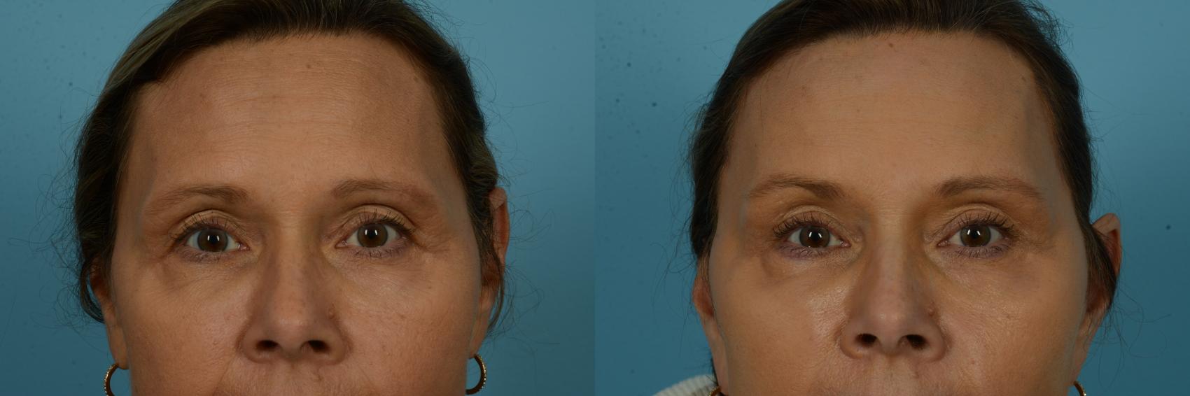 Before & After Blepharoplasty by Dr. Sinno Case 1123 Front View in Chicago, IL
