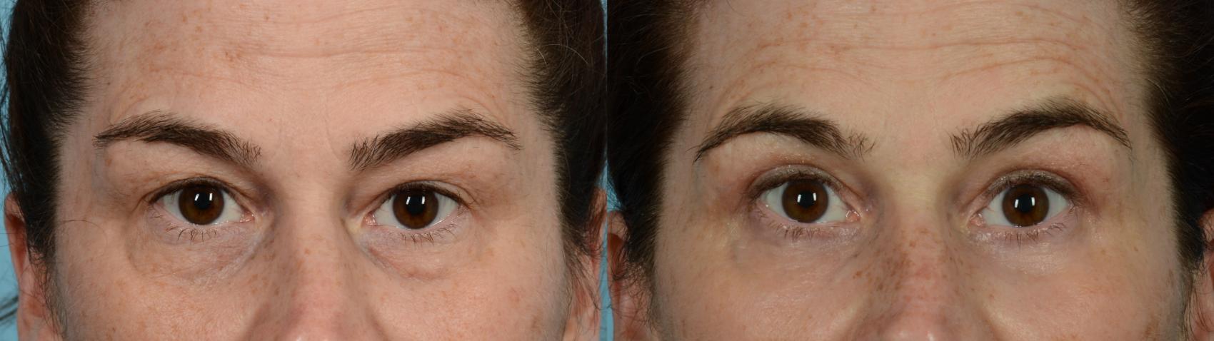 Dr. Sinno Eyelid Surgery in Chicago, Illinois