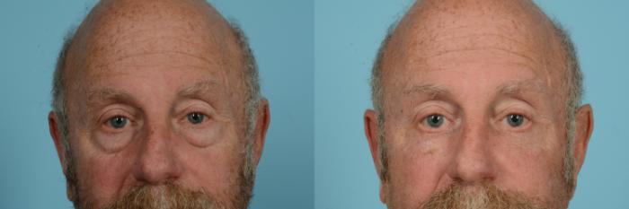 Before & After Blepharoplasty by Dr. Sinno Case 786 Front View in Chicago, IL