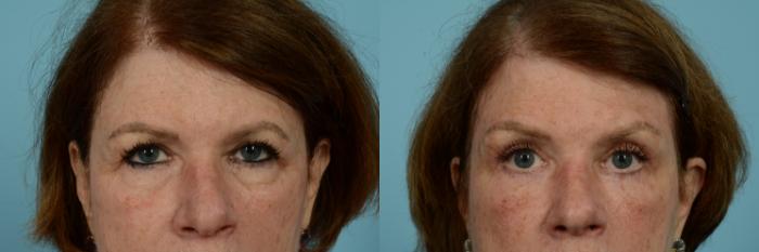 Before & After Blepharoplasty by Dr. Sinno Case 790 Front View in Chicago, IL