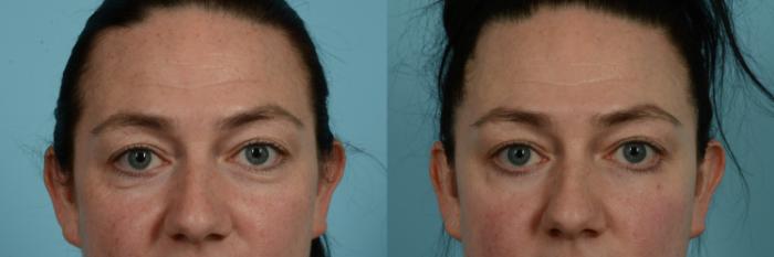 Before & After Blepharoplasty by Dr. Sinno Case 814 Front View in Chicago, IL