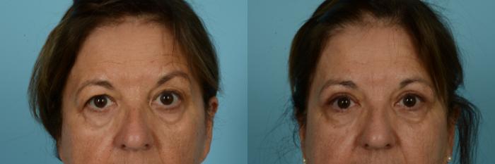 Before & After Blepharoplasty by Dr. Sinno Case 902 Front View in Chicago, IL