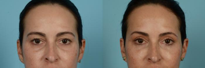 Before & After Blepharoplasty by Dr. Sinno Case 920 Front View in Chicago, IL