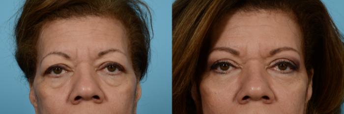 Before & After Brow Lift by Dr. Mustoe Case 925 Front View in Chicago, IL