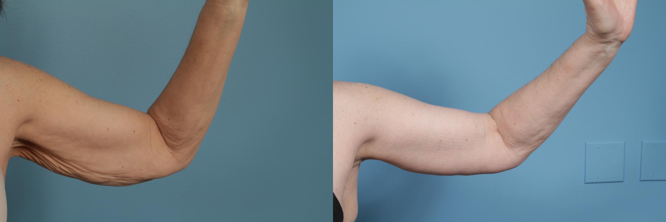 Before & After Arm Lift (Brachioplasty) Case 282 View #2 View in Chicago, IL